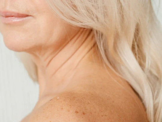 Microneedling Double Chin