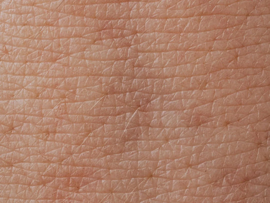 Microneedling for Hyperpigmentation