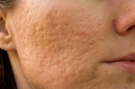 How to Get Rid of Acne Scars