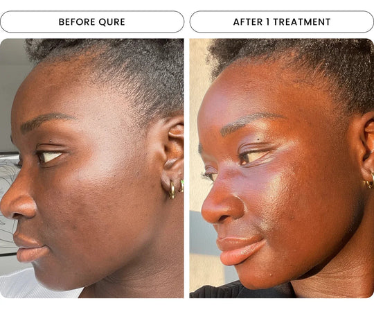 Microneedling Black Skin