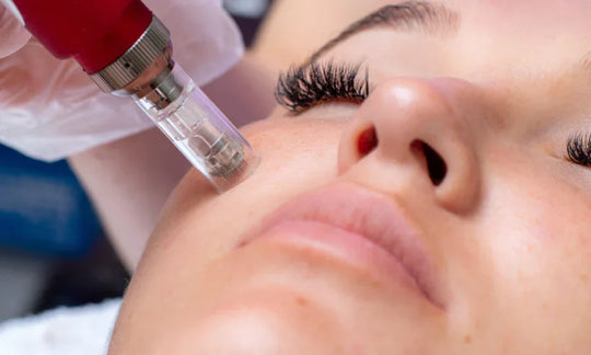 Is Microneedling Permanent?